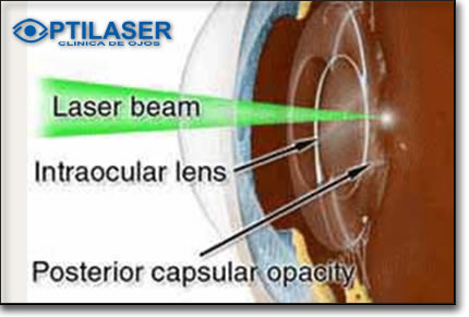 Clinica de ojos Optilaser - Capsulotomia